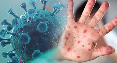 Şanlıurfa'da ilk maymun çiçeği vakası! Karantinaya alındı