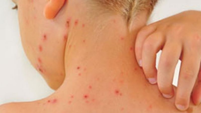 Bakanlıktan 81 ile ‘Kızamık’ uyarısı!